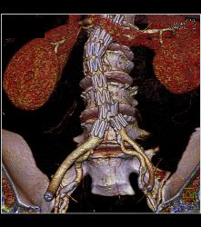 Aortic Aneurysm Repair With Stents Plus Fem-fem Bypass - CTisus CT Scan