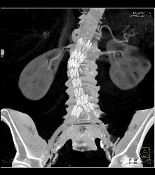 Aortic Aneurysm Repair With Stents Plus Fem-fem Bypass - CTisus CT Scan