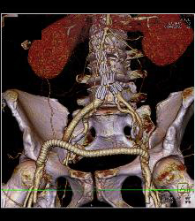 Aortic Aneurysm Repair With Stents Plus Fem-fem Bypass - CTisus CT Scan