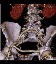 Aortic Aneurysm Repair With Stents Plus Fem-fem Bypass - CTisus CT Scan