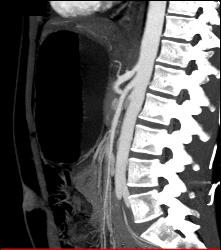 Superior Mesenteric Artery (SMA) Syndrome - CTisus CT Scan