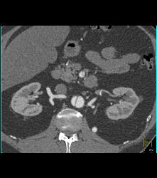 Aortic Dissection Extends Into SMA - CTisus CT Scan