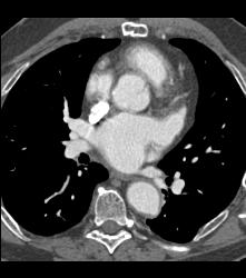 Aortic Dissection With Bypass Graft From Thoracic Aorta to Superficial Femoral Artery (SFA)- See Sequence - CTisus CT Scan