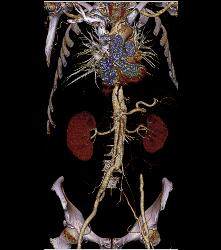 Aortic Dissection With Bypass Graft From Thoracic Aorta to Superficial Femoral Artery (SFA)- See Sequence - CTisus CT Scan