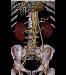 Aortic Dissection With Bypass Graft From Thoracic Aorta to Superficial Femoral Artery (SFA)- See Sequence - CTisus CT Scan