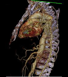 Aortic Dissection With Bypass Graft From Thoracic Aorta to Superficial Femoral Artery (SFA)- See Sequence - CTisus CT Scan