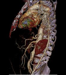 Aortic Dissection With Bypass Graft From Thoracic Aorta to Superficial Femoral Artery (SFA)- See Sequence - CTisus CT Scan