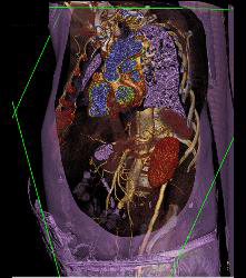 Aortic Dissection With Bypass Graft From Thoracic Aorta to Superficial Femoral Artery (SFA)- See Sequence - CTisus CT Scan