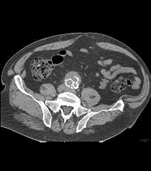 Aortic Dissection With Bypass Graft From Thoracic Aorta to Superficial Femoral Artery (SFA)- See Sequence - CTisus CT Scan