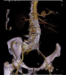 Aortic Dissection With Bypass Graft From Thoracic Aorta to Superficial Femoral Artery (SFA)- See Sequence - CTisus CT Scan