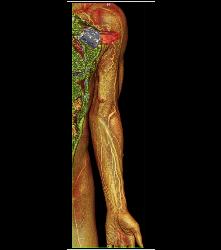 CTA of Dialysis Arteriovenous (AV) Fistulae - CTisus CT Scan