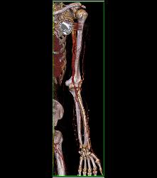 CTA of Dialysis Arteriovenous (AV) Fistulae - CTisus CT Scan