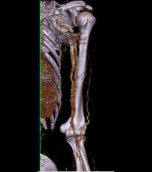 CTA of Dialysis Arteriovenous (AV) Fistulae - CTisus CT Scan