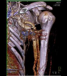 CTA of Dialysis Arteriovenous (AV) Fistulae - CTisus CT Scan