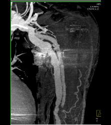 CTA of Dialysis Arteriovenous (AV) Fistulae - CTisus CT Scan