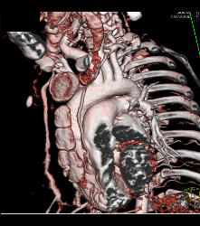 Dilated Aortic Root and Ectatic Arch Vessels in Loeys Deitz - CTisus CT Scan