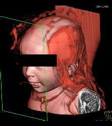 Dilated Aortic Root and Ectatic Arch Vessels in Loeys Deitz - CTisus CT Scan