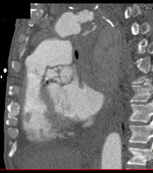 Leaking Aortic Aneurysm With Hematoma- See Full Sequence - CTisus CT Scan