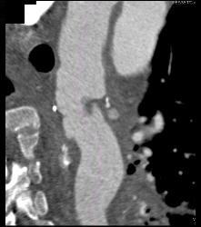 Leaking Aortic Aneurysm With Hematoma- See Full Sequence - CTisus CT Scan