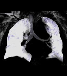 Leaking Aortic Aneurysm With Hematoma- See Full Sequence - CTisus CT Scan