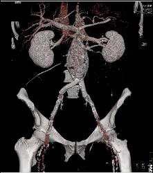 Abdominal Aortic Aneurysm (AAA) - CTisus CT Scan