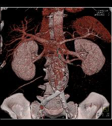 Abdominal Aortic Aneurysm (AAA) - CTisus CT Scan