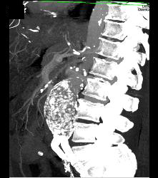 Abdominal Aortic Aneurysm (AAA) - CTisus CT Scan