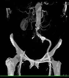 Fem-fem Bypass With Obstructed Right Iliac Artery - CTisus CT Scan