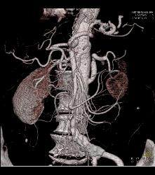 Fem-fem Bypass With Obstructed Right Iliac Artery - CTisus CT Scan