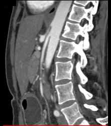 Superior Mesenteric Artery (SMA) Syndrome - CTisus CT Scan