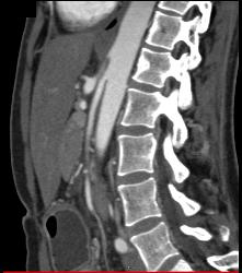 Superior Mesenteric Artery (SMA) Syndrome - CTisus CT Scan