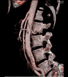 Superior Mesenteric Artery (SMA) Syndrome - CTisus CT Scan