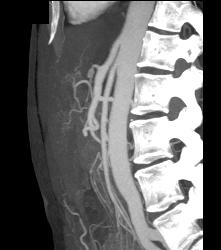 Superior Mesenteric Artery (SMA) Syndrome - CTisus CT Scan