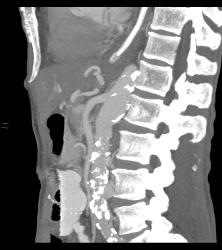 Superior Mesenteric Artery (SMA) Syndrome - CTisus CT Scan