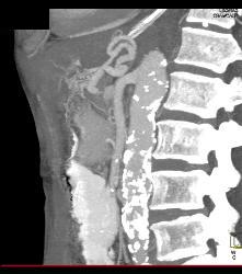 Superior Mesenteric Artery (SMA) Syndrome - CTisus CT Scan