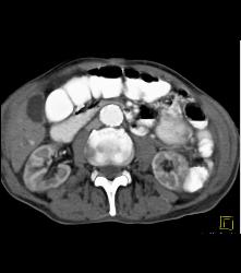 Superior Mesenteric Artery (SMA) Syndrome - CTisus CT Scan