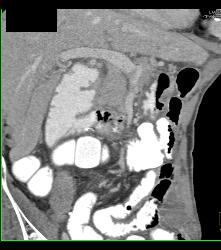 Superior Mesenteric Artery (SMA) Syndrome - CTisus CT Scan