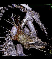 Pseudoaneurysm Off Aortic Root - CTisus CT Scan