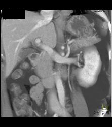 Normal Left Renal Vein - CTisus CT Scan