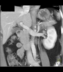 Normal Left Renal Vein - CTisus CT Scan