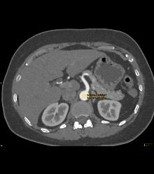 Normal Celiac Artery - CTisus CT Scan