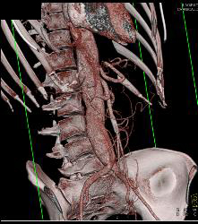 Median Arcuate Ligament Syndrome - CTisus CT Scan