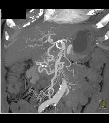 Median Arcuate Ligament Syndrome - CTisus CT Scan