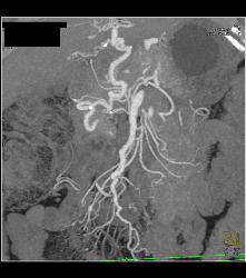 Median Arcuate Ligament Syndrome - CTisus CT Scan