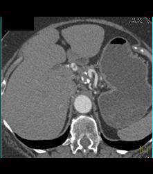 Celiac Artery Aneurysm - CTisus CT Scan