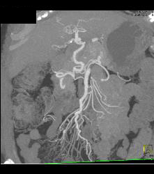 Celiac Artery Aneurysm - CTisus CT Scan