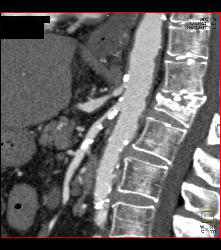 Superior Mesenteric Artery (SMA) and Celiac Stenosis - CTisus CT Scan