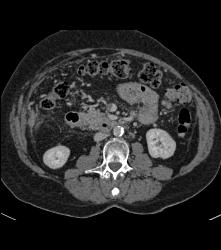 Superior Mesenteric Artery (SMA) and Celiac Stenosis - CTisus CT Scan