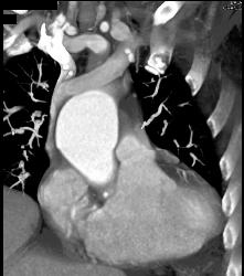 Timing for Bolus Tracking - CTisus CT Scan