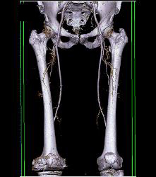 Runoff Study- See Sequence - CTisus CT Scan